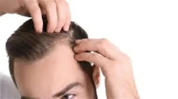 6 حلول.. طرق مضمونة لعلاج قشرة الرأس في المنزل بسهولة وسرعة